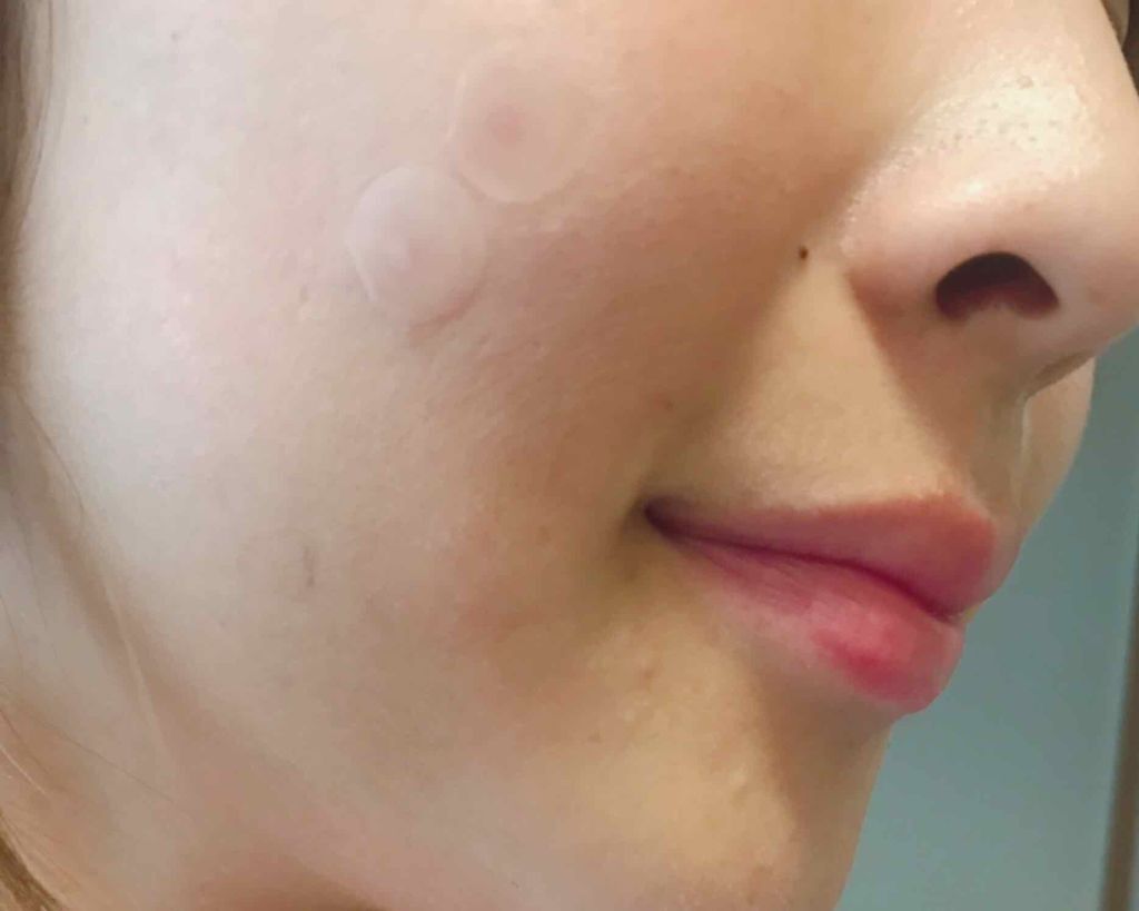韓国で人気 ニキビパッチ おすすめ9選 効果や使い方を画像付きで徹底比較 Lips