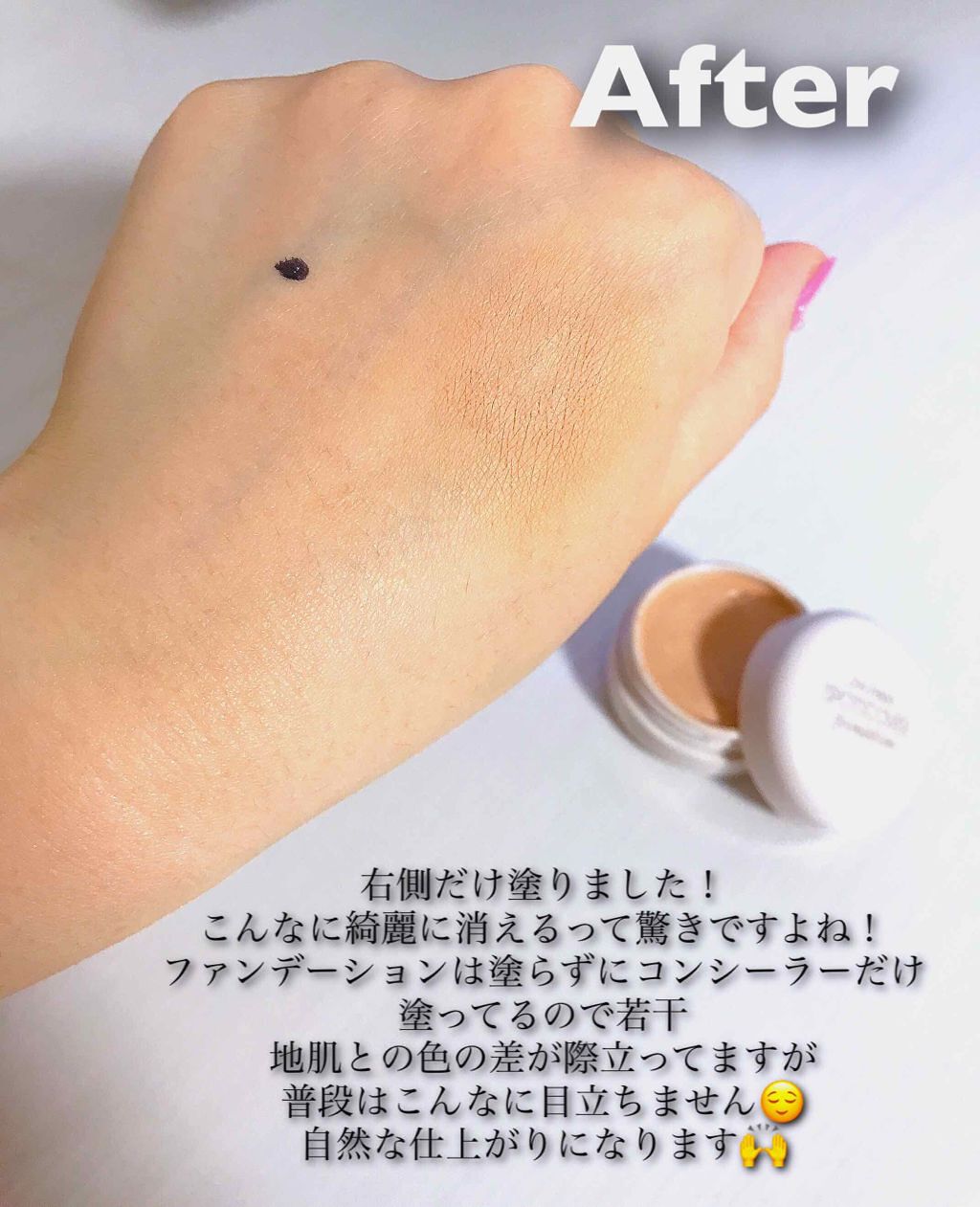 「ニキビの隠し方を徹底解説!コンシーラーの使い方やおすすめベースアイテムも」の画像(#183303)