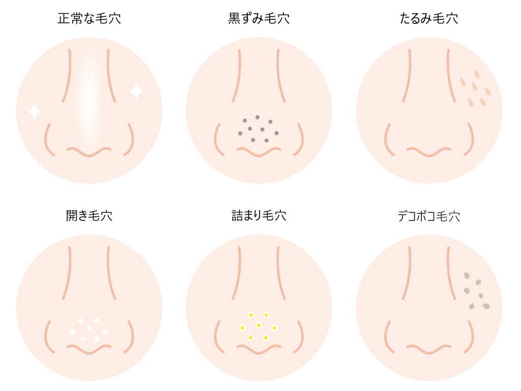 毛穴の開きの治し方は 開き方別の詳しい原因と対策 おすすめの商品を解説 Lips