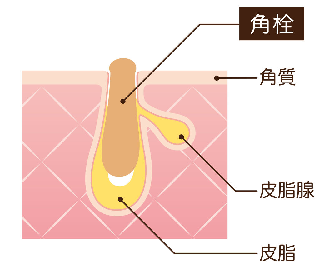 角栓はニキビの始まり?正しいケア方法と予防方法でツルスベたまご肌を手に入れよう♪の画像
