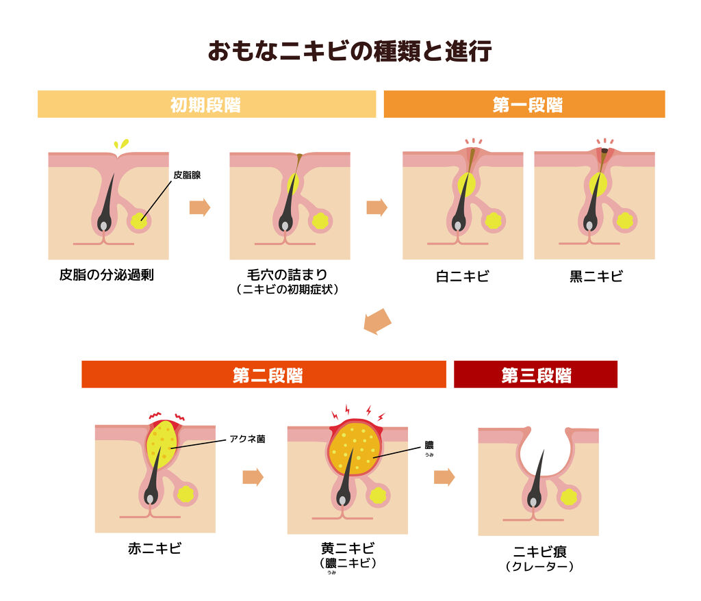 膿でパンパンのニキビは潰していい 潰れたらどうする ニキビの原因とケア方法も解説 Lips