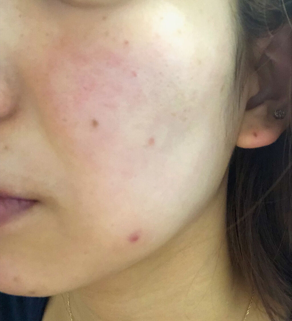 シミ対策クリームを使って早めに予防スキンケア!【選び方とおすすめアイテム10選】の画像
