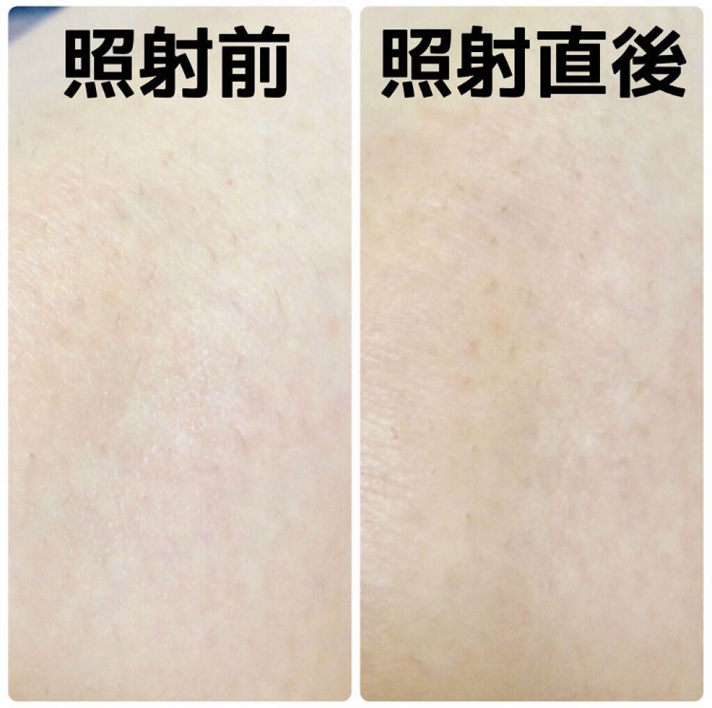 「水着もノースリーブもおもいきり楽しめる!ムダ毛ケアグッズで夏の肌見せに自信♡」の画像(#87523)