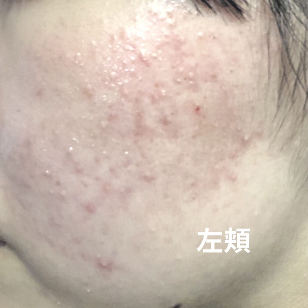 A アクネフォーム Novを使った口コミ 肌断食3日目 昨日より何だか赤みが引いた気 By にゃ ᐢ ˬ ᐢ 脂性肌 10代後半 Lips