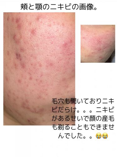 A アクネフォーム Novを使った口コミ ニキビのスキンケアと皮膚科で処方箋される薬 By りな 乾燥肌 Lips