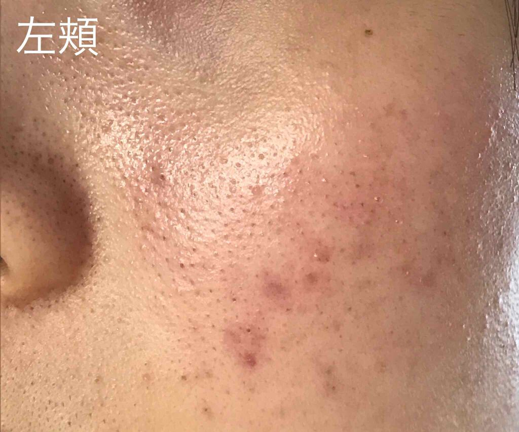 スキンケア方法 ペアアクネクリームw 医薬品 ペアの使い方 効果 こんにちは 高校生の女 By ひな Lips