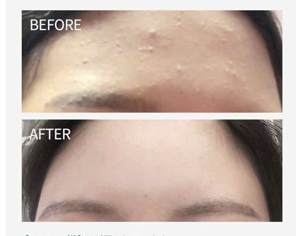 Heartleaf 77 Soothing Toner Anuaの効果に関する口コミ 低刺激 肌荒れに最強の化粧水 今回 By はなれ 普通肌 Lips