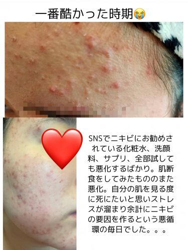 A アクネフォーム Novの効果に関する口コミ 乾燥肌におすすめの洗顔フォーム ニキビのスキンケアと皮 By りな 乾燥肌 Lips