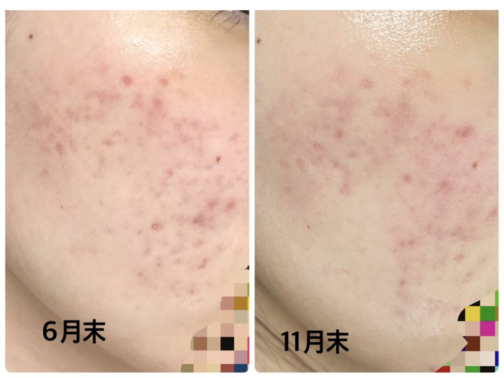 Vt Cica デイリー スージング マスク Vt Cosmeticsを使った口コミ ニキビ跡肌荒れ推移 今月思ったこと写真の通 By みずみず 混合肌 代後半 Lips