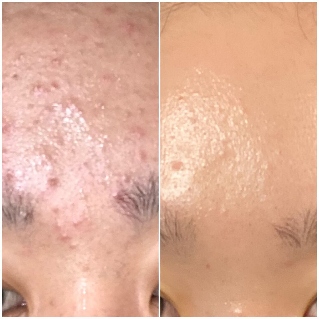 ボタニカルジェルクレンジング ナイス クイックを使った口コミ 小学生から高校３年生までずっとニキビ肌を悩 By Ty Lips