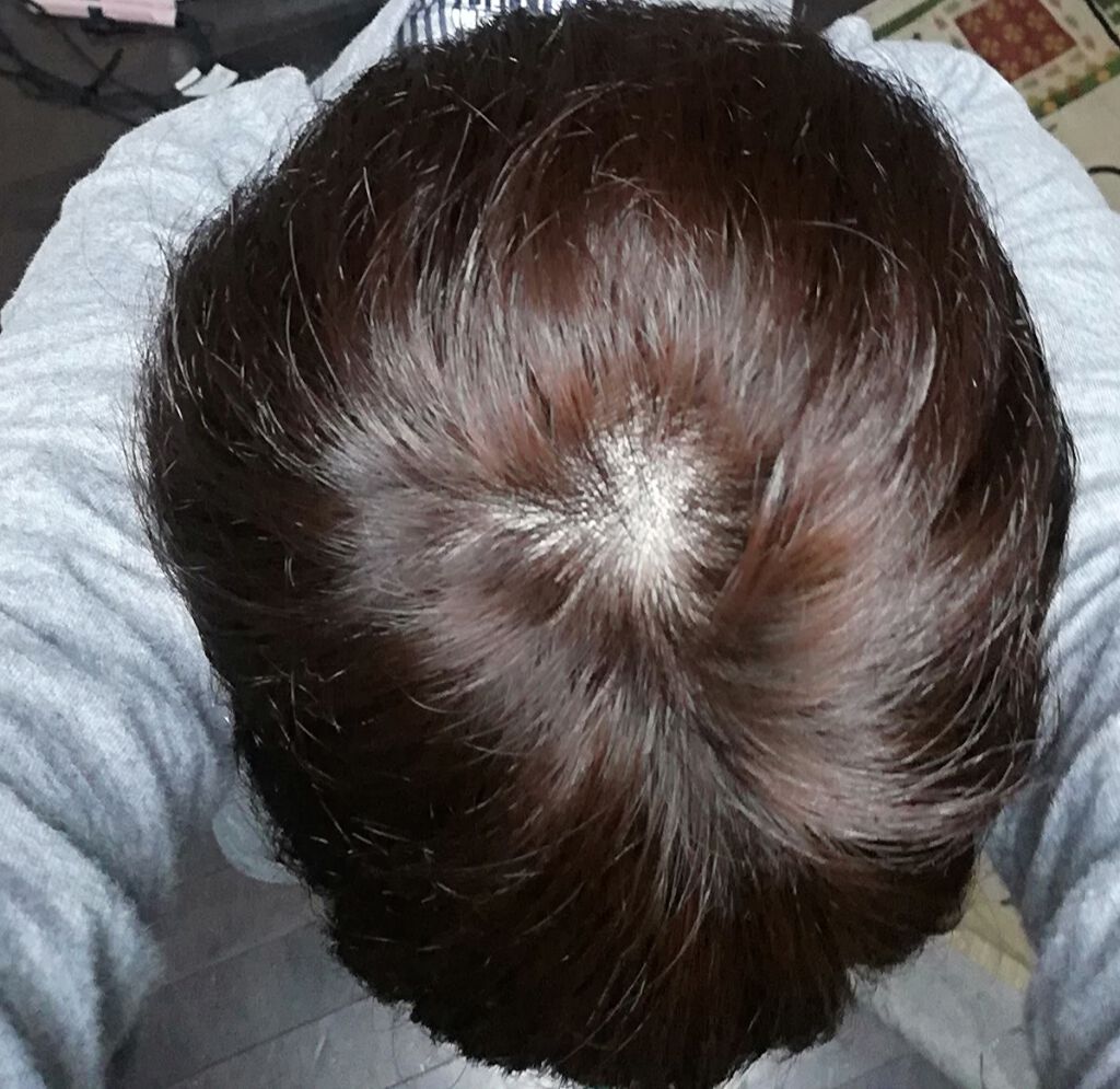 泡カラー 医薬部外品 リーゼの口コミ 頭の写真すいません 写真一枚目染める By 保育士まま アトピー肌 30代前半 Lips