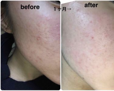 ベピオゲル 医薬品 の口コミ お久しぶりです 皮膚科に行って1ヶ月私の親 By とあるニキビと戦うjk 混合肌 10代後半 Lips