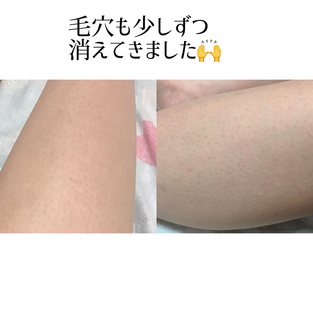家庭用脱毛器 ケノン Ke Non エムテックの口コミ 1年ぶりの しまのケノン報告サムネ By しま 代前半 Lips 家庭用脱毛器 ケノン Ke Non エムテックの口コミ 1年ぶりの しまのケノン報告サムネ By しま 代前半 Lips