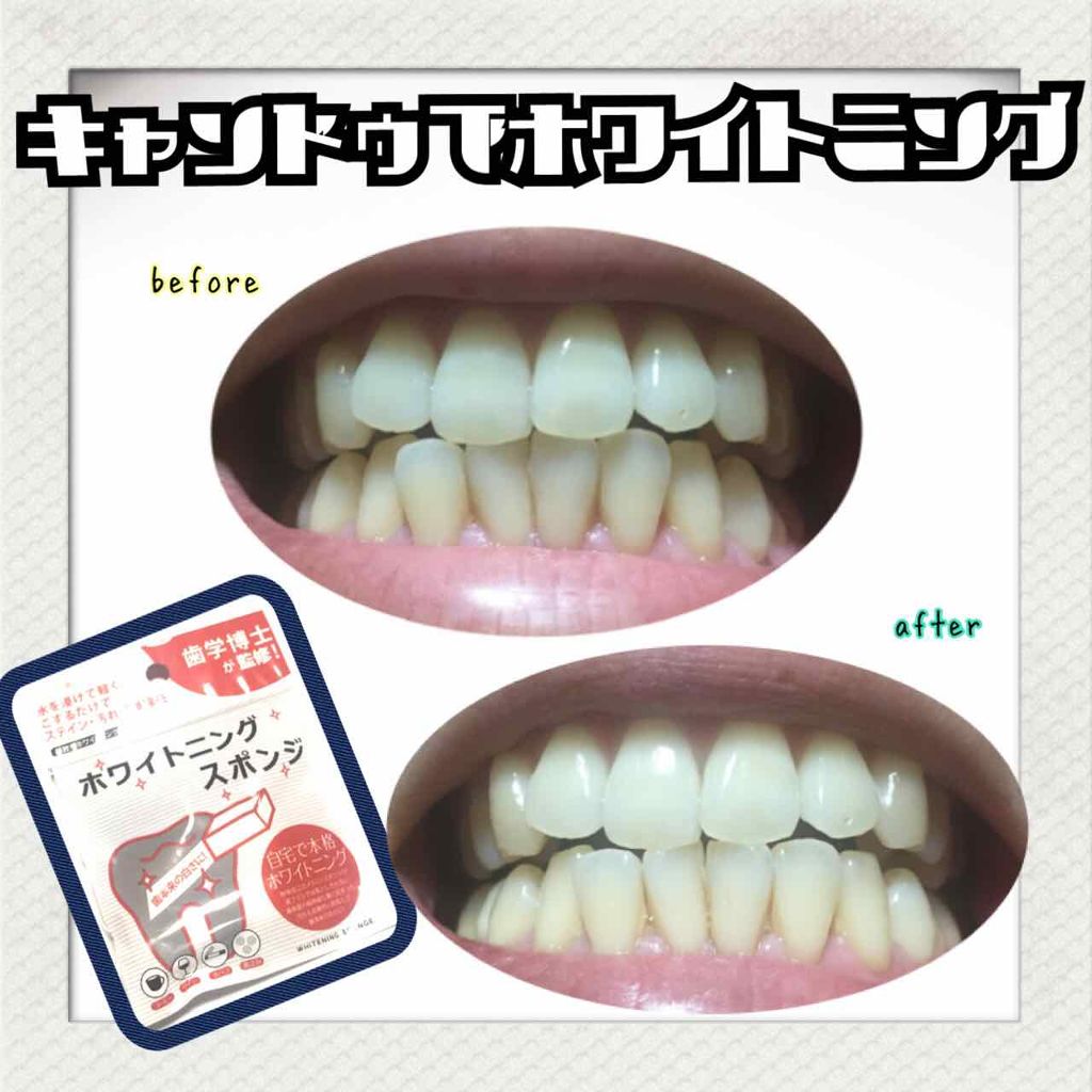ホワイトニングスポンジ キャンドゥの使い方を徹底解説 キャンドゥで売られているホワイトニングスポ By Enu 混合肌 代前半 Lips