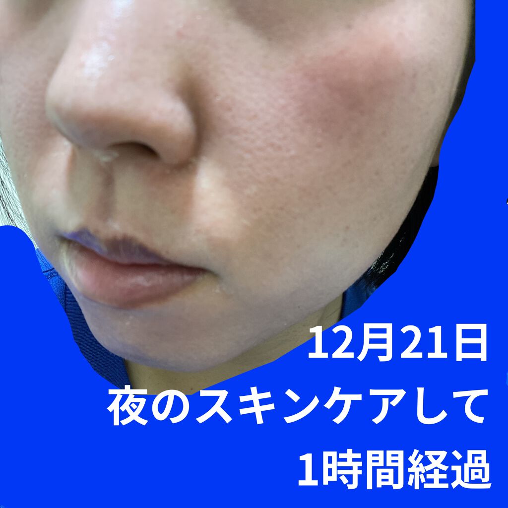 ミラミックス Zo Skin Healthの口コミ ゼオスキンのセラピューティック11週目中の By ワタクシ ブルベ冬 敏感肌 30代前半 Lips