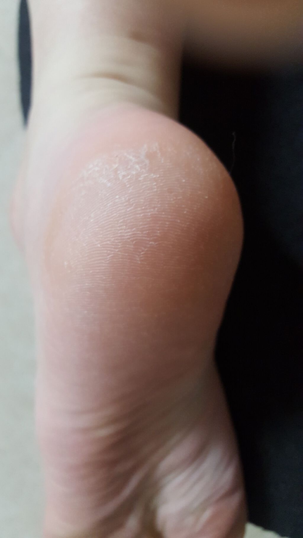 足用角質クリアハーブ石けん フットメジの辛口レビュー 初めから汚い画像ですみませんかかとが硬い By ゆーか 乾燥肌 30代前半 Lips