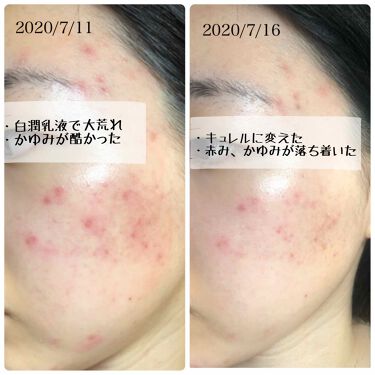 化粧水 Ii しっとり キュレルを使った口コミ こんにちは 前回の投稿でロート製薬の白潤乳 By Sari 混合肌 代前半 Lips