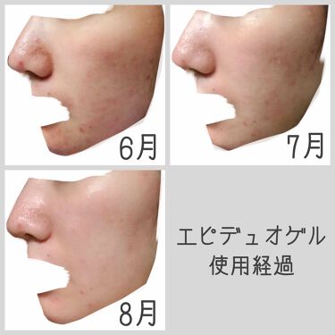 さいきa 保水治療ローション 医薬品 Saikiを使った口コミ 無加工の肌の写真があるので閲覧注意でお願 By Lol 混合肌 代前半 Lips