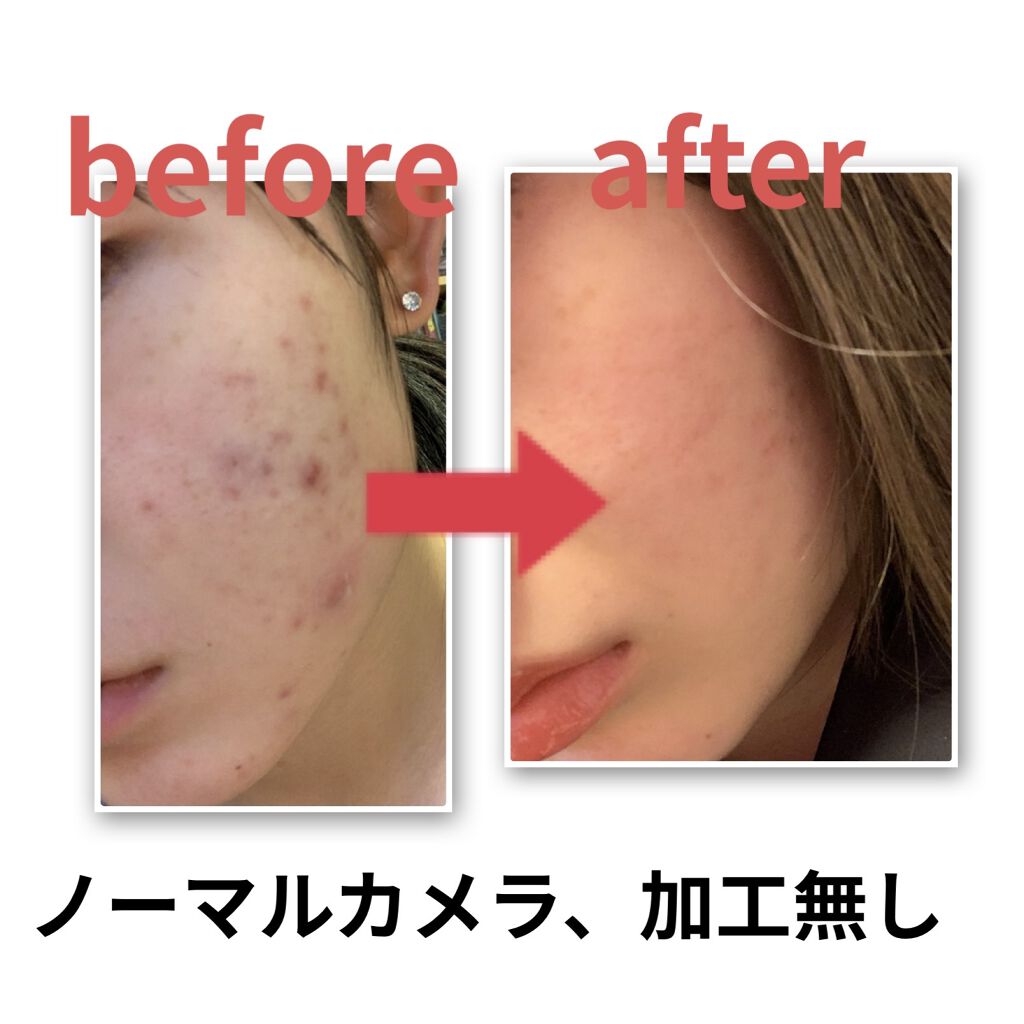 白色ワセリン 医薬品 健栄製薬の口コミ マスクで肌荒れしてしまった人必見 By Apricot 敏感肌 10代後半 Lips