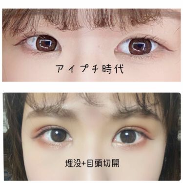 二重整形の口コミ 私の二重整形について 本日は私の二重整形 By うぱ 普通肌 代前半 Lips