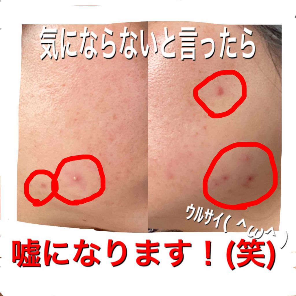 ベピオゲル 医薬品 の口コミ こんばんは 自宅待機が長引きそうですが皆さ By Amin 敏感肌 30代前半 Lips