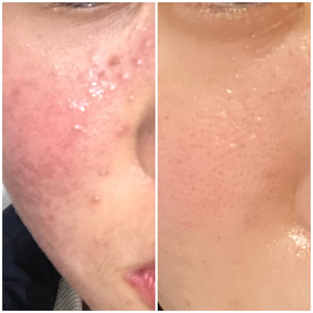 ボタニカルジェルクレンジング ナイス クイックを使った口コミ 小学生から高校３年生までずっとニキビ肌を悩 By Ty Lips