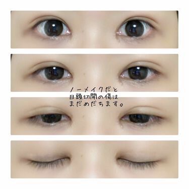 二重整形の口コミ 二重整形から約2ヶ月経過しました まず By うぱ 普通肌 代前半 Lips