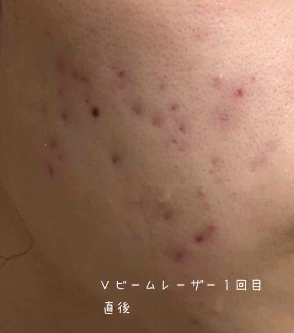 大人気定番】 ケノン 脱毛器 qSj0N-m13403233972 zonalogistica.com