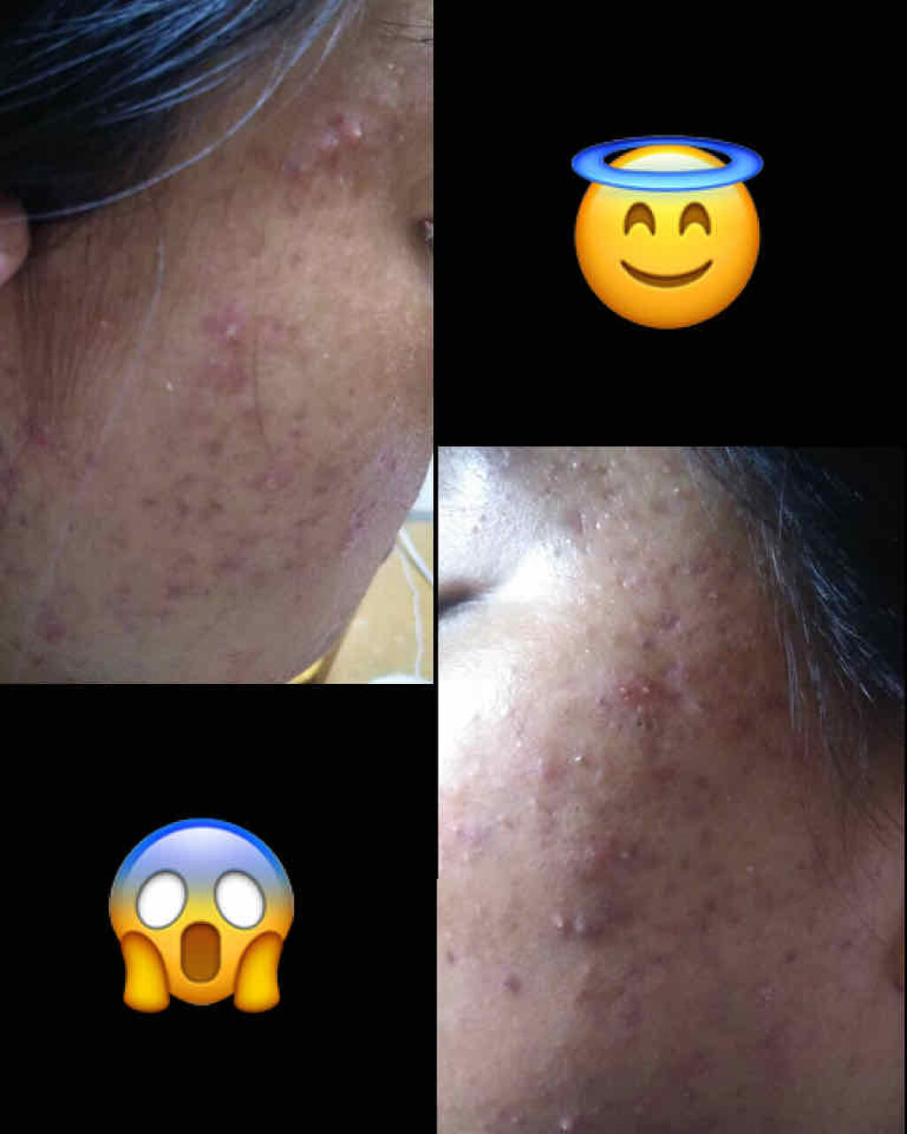 ベピオゲル 医薬品 の口コミ 幼稚園の頃から体質で悩んでたニキビが ど By びび 脂性肌 Lips