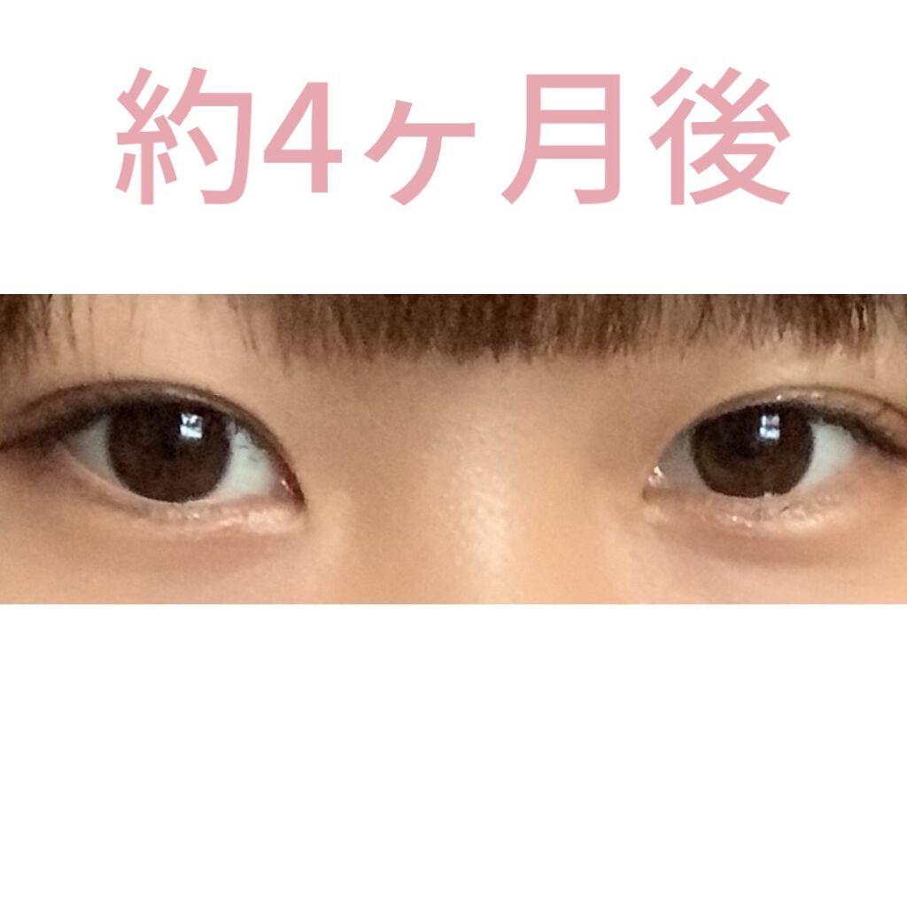 二重整形の口コミ みなさんはじめまして 二重整形 埋没 を By ｽｽﾞｶ 10代後半 Lips