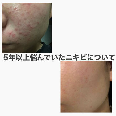 モイスチャーローション プロメディアルを使った口コミ 初投稿 よろしくお願いします 中学1年 By ゅ ﾟ 敏感肌 10代後半 Lips