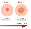薬用アクネジェル メンソレータム アクネスを使った口コミ 私はニキビができた時は 絆創膏を使って治し By なな 10代後半 Lips