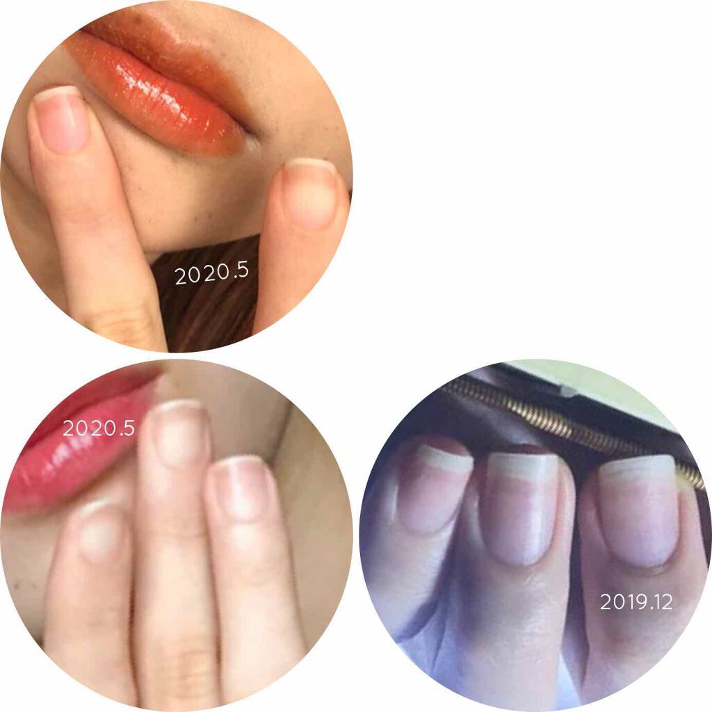 ビューティーチャージ アトリックスを使った口コミ 育爪うまくいかない話 小学校4年生まで爪 By てらお 敏感肌 代後半 Lips