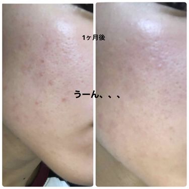 ベピオゲル 医薬品 の口コミ お久しぶりです とあるニキビと戦うjkで By とあるニキビと戦うjk 混合肌 10代後半 Lips