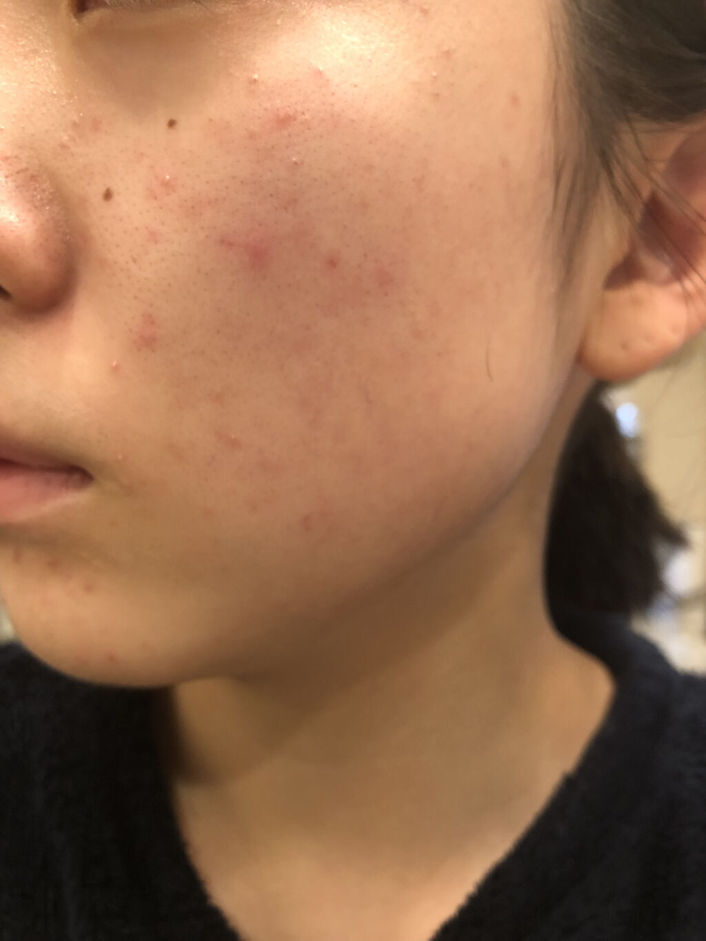 カウブランド 赤箱 しっとり カウブランドを使った口コミ 閲覧注意 肌荒れ女子の肌断食日記 ほ By 肌荒れ女子 混合肌 10代後半 Lips カウブランド 赤箱 しっとり カウブランドを使った口コミ 閲覧注意 肌荒れ女子の肌断食日記 ほ By 肌荒れ女子 混合肌 10代後半 Lips