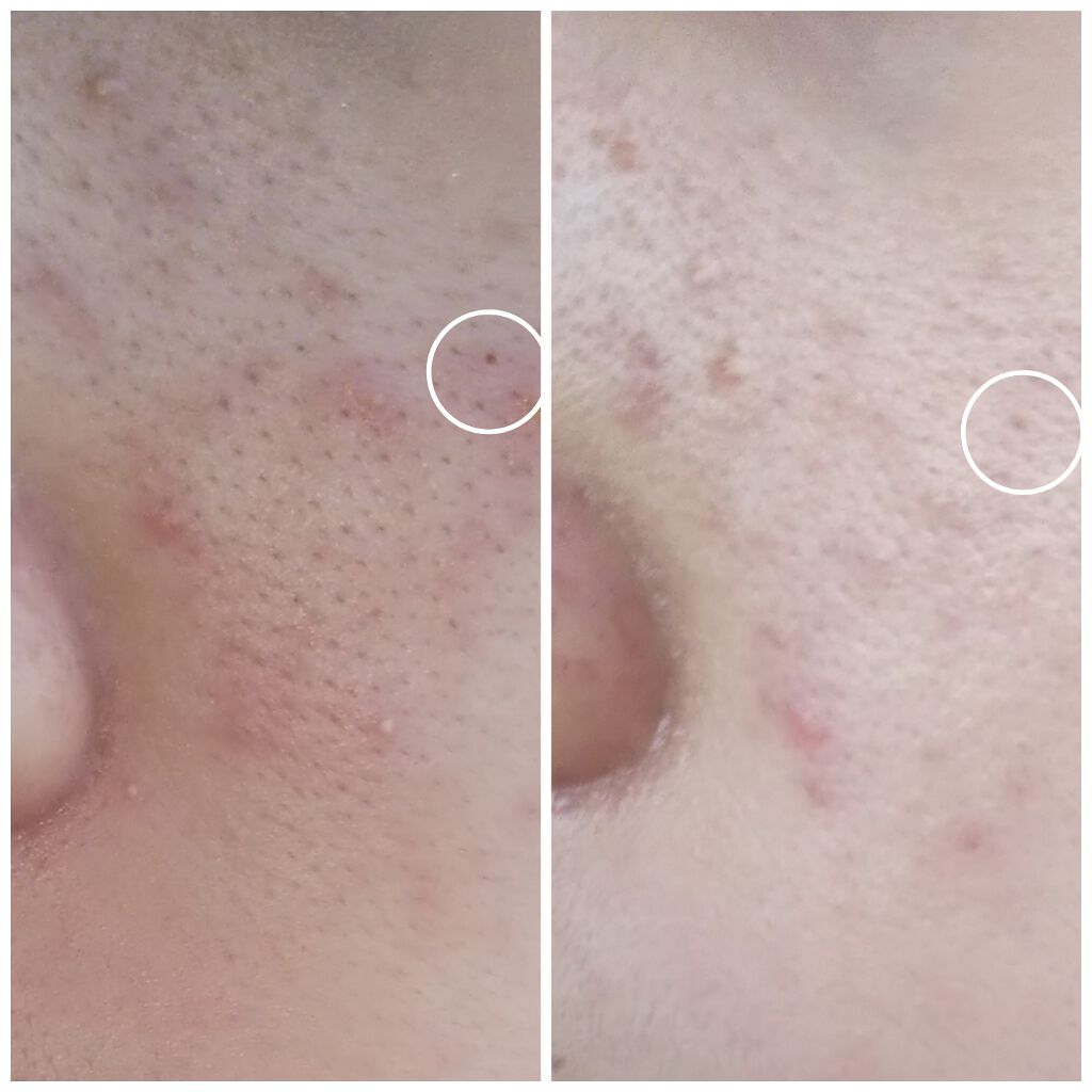 スキンケア方法 ウォッシャブル コールド クリーム ちふれの使い方 効果 これで毛穴の汚れは By ままみ 混合肌 Lips