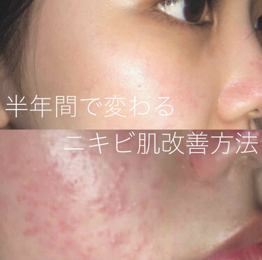 スキンコンディショナー高保湿 Cezanneを使った口コミ ニキビ肌 肌荒れ ニキビ ニキビスキンケ By Mumu 敏感肌 10代後半 Lips