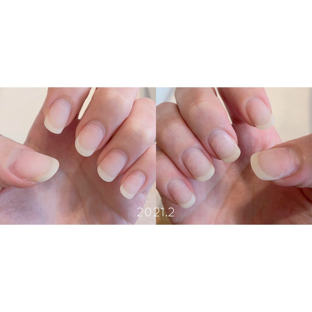 ビューティーチャージ アトリックスを使った口コミ 育爪経過報告 1月 2月 もう3月だけど By てらお 敏感肌 代後半 Lips