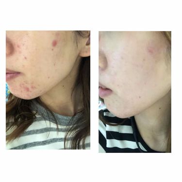 極潤 ヒアルロン液 旧 肌ラボを使った口コミ 初めまして ᐛ あむです Lipsはもうず By あむちゃん 混合肌 代後半 Lips