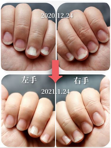 クイックケアコート Ettusaisを使った口コミ 爪甲剥離症の育爪記録以前の投稿はこちらに By かぴめろん マイペース 乾燥肌 40代後半 Lips