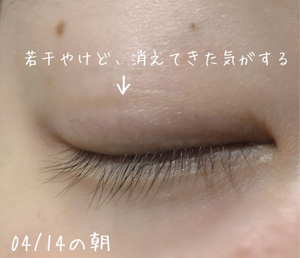 ダブルラインエキスパート Kateの口コミ 色素沈着しました色素沈着が無くなるまで 経 By Luna 混合肌 代前半 Lips