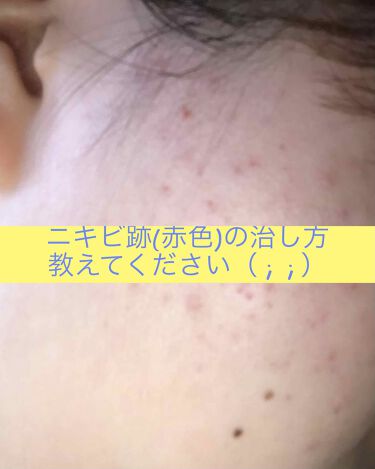 オロナインｈ軟膏 医薬品 オロナインの口コミ ニキビ跡の治し方を教えてください 画像２ By さくらんぬ フォロバ100 脂性肌 10代後半 Lips