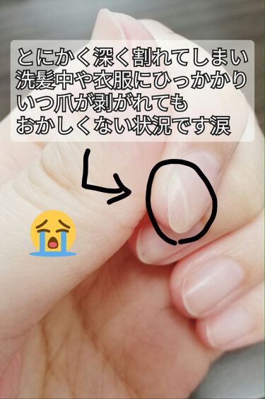肌色タイプ バンドエイドを使った口コミ 深く割れてしまった爪の修復技 あく By Chan あーちゃん Lips