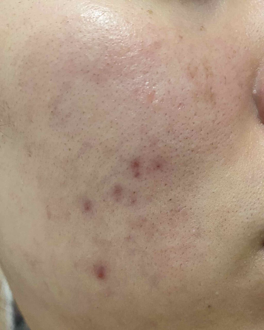 ハトムギ洗顔フォーム 株式会社イヴを使った口コミ 肌荒れ 悪化しました もう最悪です By さい 脂性肌 代前半 Lips