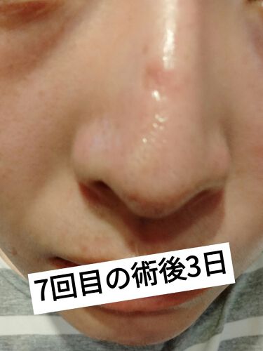 ダーマペン ダーマスタンプ Mymのリアルな口コミ レビュー Lips