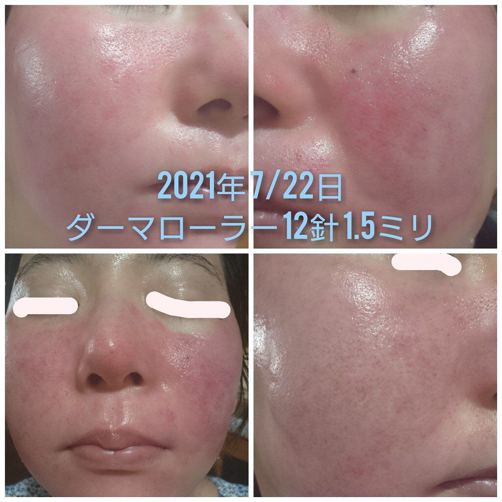 Vt Cica デイリー スージング マスク Vt Cosmeticsを使った口コミ 毛穴にきび跡クレーター治療 セルフでダーマ By ふわふわ 混合肌 30代後半 Lips