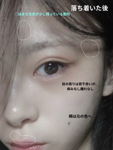 オリーブバージンオイル Dhcを使った口コミ 皮膚炎 アトピーで悩んでいる人の為のマニュ By 黄鶲 敏感肌 20代前半 Lips