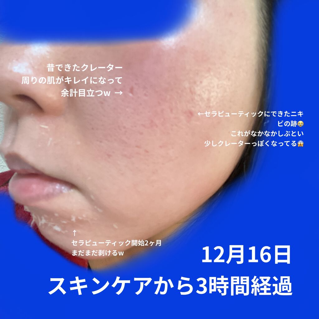 ミラミン Zo Skin Healthの使い方を徹底解説 昨夜12月15日にミラミン使い切り バラ By ワタクシ ブルベ冬 敏感肌 30代前半 Lips