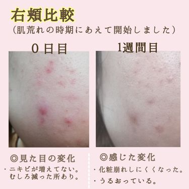 厚い 商業の シェル イプサ 化粧 水 ニキビ 跡 Tanseeq Org