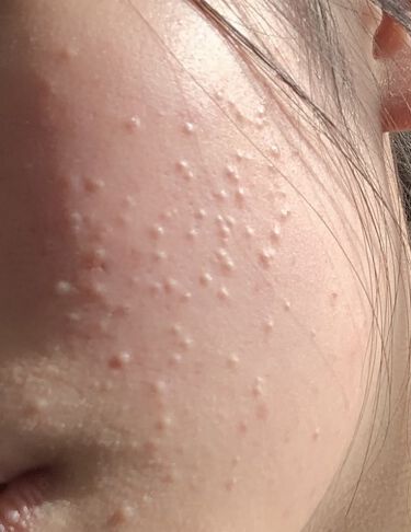 ニキビが治らない原因 東京 大阪の美容皮膚科ならflalu フラルクリニック